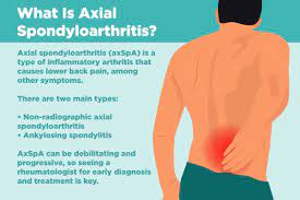 Maybe you would like to learn more about one of these? What Is Axial Spondyloarthritis Symptoms Causes Diagnosis
