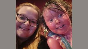 Image result for Ichthyosis