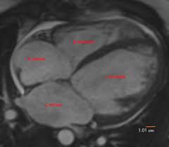 Image result for Cardiac MRI