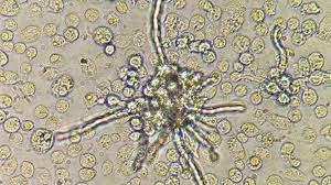 La mucormicosis es una infección fúngica producida por el orden de los mucorales de la familia de los zigomicetos, afecta principalmente a individuos inmunocomprometidos, tiene una alta tasa de. Que Es La Mucormicosis La Nueva Amenaza Tras El Covid 19 Con Un 90 De