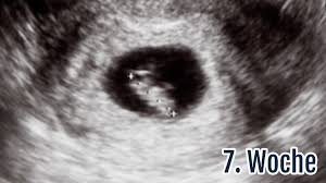 Schwangerschaftswoche geht es mit der entwicklung des embryos rasant weiter. 7 Ssw Die 7 Schwangerschaftswoche Anzeichen Ultraschall Tipps Netmoms De