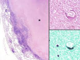 We did not find results for: Histopathologic Review Of Granulomatous Inflammation Sciencedirect