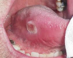 Image result for cancer of tongue