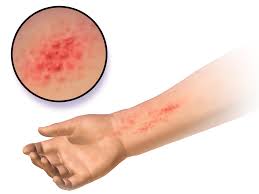 Image result for dermatitis contacta