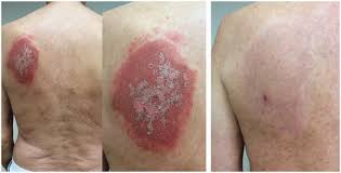 Image result for Radiation Dermatitis