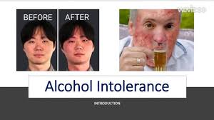 Nov 12, 2018 · you may also experience other symptoms, such as: Alcohol Intolerance Alcohol Allergy Youtube