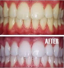 Blanqueamiento Poner Un Poco De Pasta De Dientes En Una Taza Pequena Mezcle En Una Cucharadita De Bicarbonato De So Beauty Hacks Health And Beauty Diy Beauty