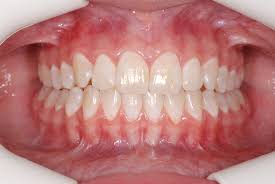 For 24 months ($3635) custom clear aligners shipped to you. Braces Or Invisalign No Contest The Choice Is Clear Caring 4 Smiles