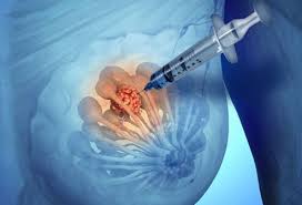 These nodules, if bumped or scratched, may bleed. Breast Cancer Awareness Symptoms Diagnosis And Treatment