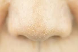 Blackheads are divided into two types, namely, aka white blackheads whiteheads, and blackheads black or. 11 Cara Alami Menghilangkan Komedo Ini Bikin Wajah Bening Bercahaya
