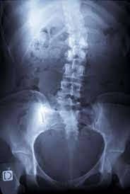 L'épaule gauche est un peu plus haute. Scoliose Diagnostic Pourquoi Docteur