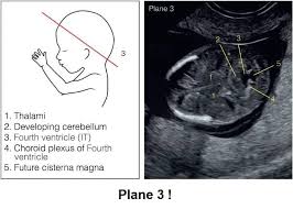 Pin By Fatima Aguero On Dms Obstetric Ultrasound Ultrasound Sonography Ultrasound