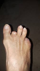 Image result for toe amputation