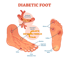 Image result for diabetic toes