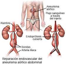 Aneurisma De La Aorta Abdominal Sin Ruptura Care Guide Information En Espanol