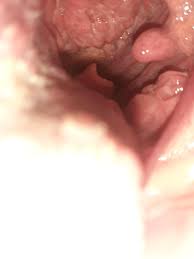 You will feel a limp in the throat and coughing will be chronic. Lingual Tonsils Bumps Reddit