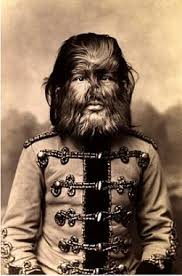 Image result for Hypertrichosis