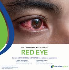 Image result for Viral Conjunctivitis