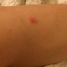 Wann sie nach einem zeckenbiss zum arzt gehen sollten. Zeckenbiss Stelle Gerotet Soll Ich Damit Zum Arzt Gesundheit Entzundung Zecken