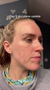 Acne Treatment Journey: Day 5 Accutane Update