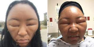 Hair coloring products contain many ingredients that can irritate the skin and cause allergic reactions. 24 Best Hair Dye Allergy Ideas Hair Dye Allergy Dyed Hair Hair