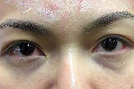 Berminat nak belajar tentang saham patuh syariah klik sini ==>> saham. Rawatan Hilangkan Lingkaran Hitam Gelembung Bawah Mata Berita Gaya Hidup Beritaharian Sg