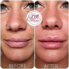 Lips of london aesthetics · 09/02/2022. Am Aesthetics Anti Wrinkle Treatment Dermal Fillers
