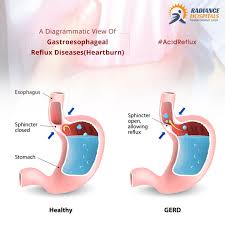 Knowing Is The First Step To Well Being Know Your Gerd And Fight It Better Gastroesophageal Reflux Disease Reflux Disease Gerd
