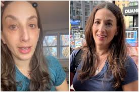 High Cholesterol Leaves Woman With 'Most Severe' Eye Bags Surgeon Has Seen 