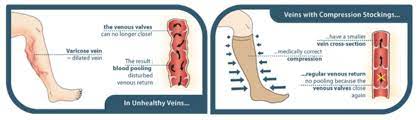 Compression Socks For Edema The Ultimate Guide