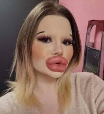 She has the world's biggest lips, and now wants huge cheekbones to match...  You had better sit down before you see how she looked before👇🏻👇🏻 Check  in comments...