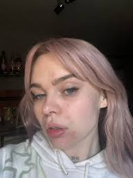 Hey all! The top three photos were last year but I tend to get these rashes  and I have near enough all signs and symptoms for lupus. I brought it up  with