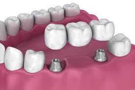 Bridges for Rockville, MD | Tiger Family Dental Care | Dentists