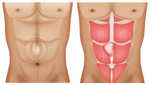Il faut traiter la hernie et la complication. Hernie De La Ligne Blanche A Lyon Symptomes Et Traitement