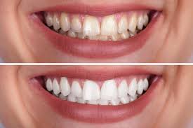 Get it as soon as thu, aug 19. Diy Tooth Whitening Vs Professional Teeth Whitening Bonham Dental
