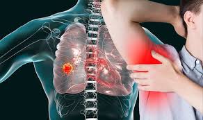 There are many causes of armpit pain, from a mild muscle strain to more serious conditions like breast cancer. Lung Cancer Symptoms Signs Include Lump Or Swollen Areas In Armpit Express Co Uk