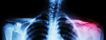 I've talked about these before, and i use them quite extensively in my applications. Clavicle Fractures Johns Hopkins Medicine