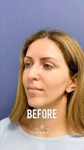 ניתוח אף ראשוני ✨ רינופלסטי ✨ ד״ר פיכמן , 3 חודשים לאחר ניתוח אף אולטרסאוני  בגישה פתוחה. התוצאה