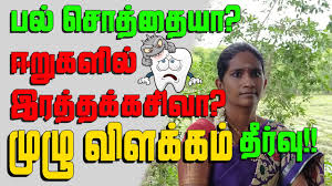 Although more studies are needed to confirm the potency of oil pulling at preventing cavities, oil pulling has been named as a method to prevent cavity. How To Cure Dental Decay In Tamil à®ªà®² à®š à®¤ à®¤ à®• à®£à®® à®• à®Žà®³ à®¯ à®‡à®¯à®± à®• à®µ à®¤ à®¤ à®¯à®® Ayurveda Health Tamil Youtube