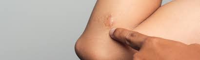 Image result for Skin Tear