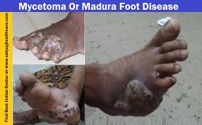 Madura foot is caused by a fungus that lives in soil, so is very common among barefoot agricultural workers. Satyug Health Care Best Doctor For Mycetoma Or Madura Foot Treatment In India