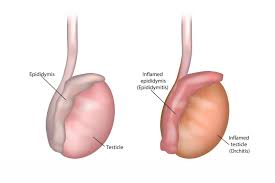 The key to proper testicular function and health is better blood circulation to the area. Epididymitis And Orchitis Guide Causes Symptoms And Treatment Options