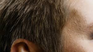 Maybe you would like to learn more about one of these? Dermaroller For Hair Loss An In Depth Guide Hairverse