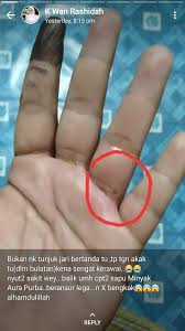 Cara surutkan bengkak buku lali paling berkesan. Aireen Kerawai Atau Penyengat Sy Rasa Sama Je Kot Korang Panggil Ape Ye Cara Nk Surutkan Bengkak Hilangkan Sakit Kesan Gigitan Serangga Spray Map Di Tempat Sakit Insyaallah Beransur Pulih