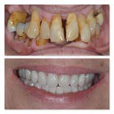Before and after dentures uk. Dental Implant Retained Denture Leeds Rehabilitation