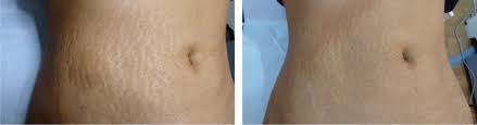 During treatment, radio frequency waves are emitted to the affected skin and penetrate below the stretch marks can usually occur quite suddenly and can affect numerous different areas of the body. Stretch Marks Pregnancy Stretch Marks Stretch Marks Treatment Clinic
