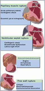 Image result for Myocardial Infarction Stabilization