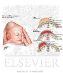 Image result for Cephalhematoma