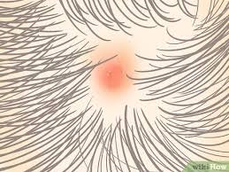 Check spelling or type a new query. How To Check For And Identify Head Lice Nurse Reviewed Advice
