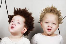 Parents Of Albino Black Twins Are Sick Of People Asking If The Kids Are Theirs Sick Of People People Black Twins